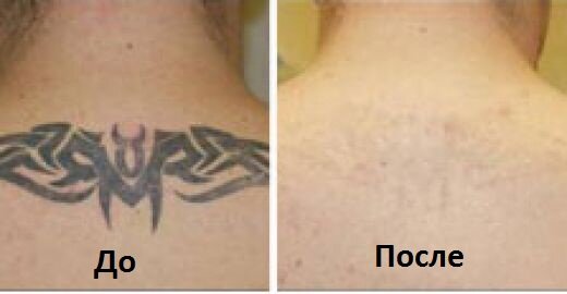 удаление татуировок лазером